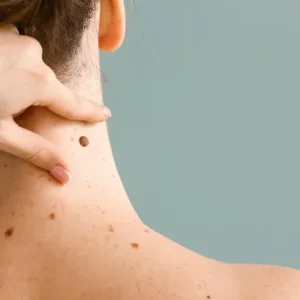 Neck Warts Remedies: गले के आसपास हो गए हैं छोटे मस्से? अपनाएं ये घरेलू उपाय, दिखने लगेगा असर
